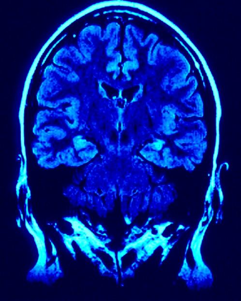 brain scan